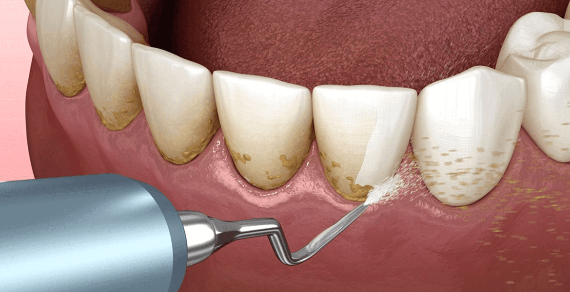 Detartrajul profesional – Esențial pentru o igienă completă, disponibil la Z Clinic în Oradea