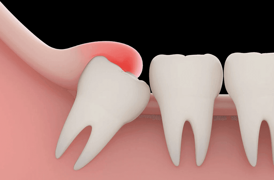 Extracția măselei de minte: când e necesară și unde o poți face în Oradea