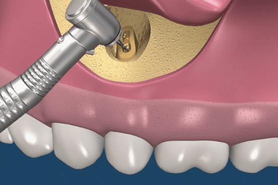Rezecția apicală: soluția chirurgicală pentru infecțiile dentare persistente în Oradea